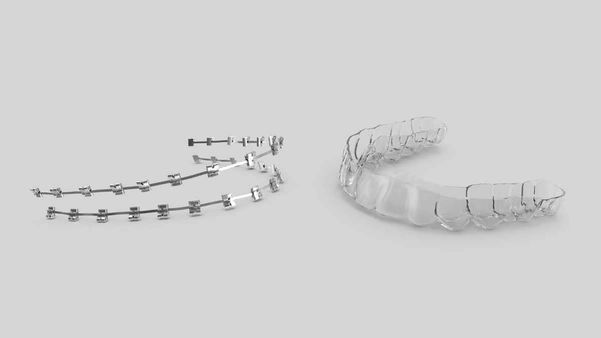 Braces or Invisalign Braces or Invisalign