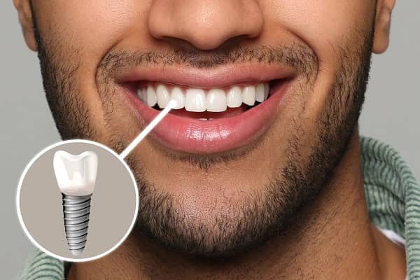Dental Implants in Oakville Dental Implants in Oakville