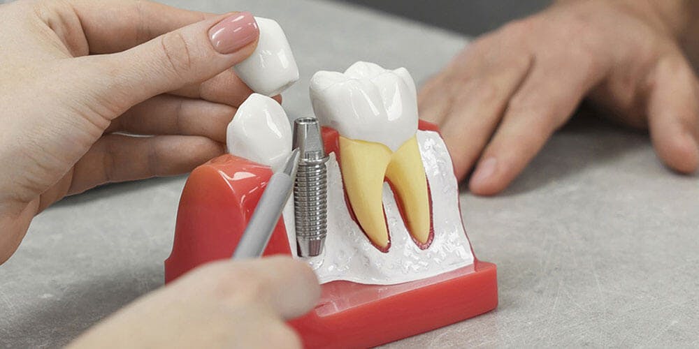 The Benefits of Getting Dental Implants for Missing Teeth The Benefits of Getting Dental Implants for Missing Teeth